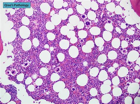 Trombocitemia Esentiala (TE) 